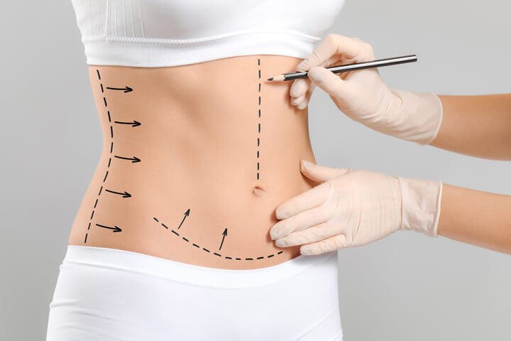 Abdominoplastia